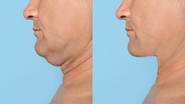 Which Non-Surgical Treatments Work Best for Jowls and Loose Skin Runcorn?
