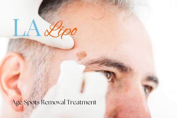 What Are the Most Effective Treatments for Age Spots Runcorn?