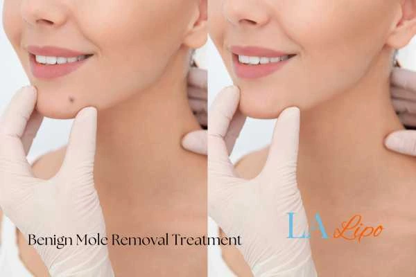 woman's before and after mole removal Runcorn results