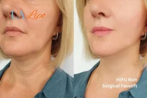 hi-fu for wrinkles Runcorn before and after results