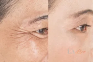 Before and after results of woman - HI-fu wrinkles reduction treatment Runcorn