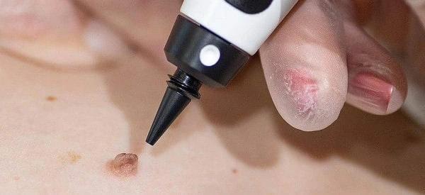 skin tag removal using cryopen Runcorn