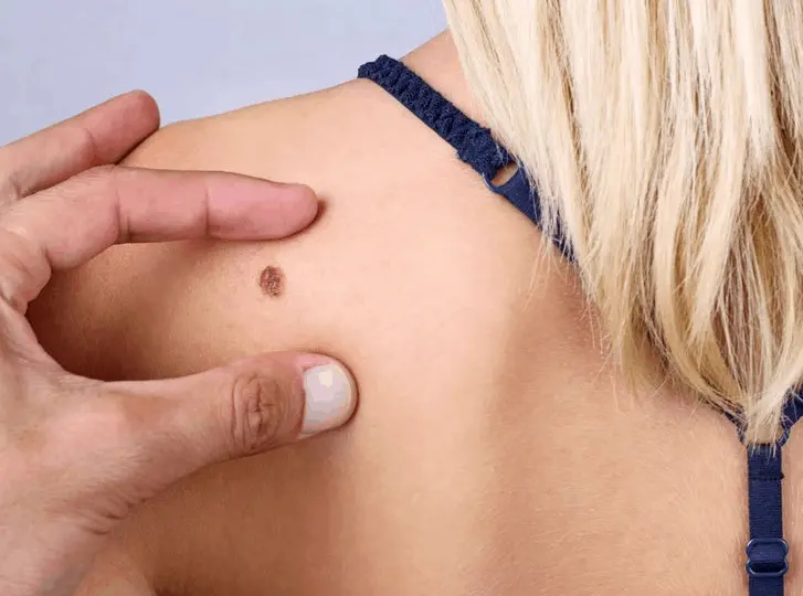 woman having mole removal Runcorn consultation before treatment.