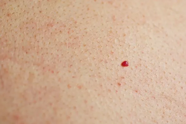 close up of a cherry angioma Runcorn