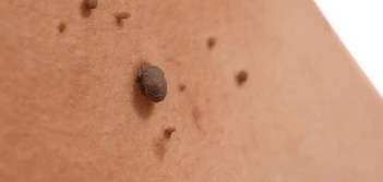 image of a skin tag Runcorn