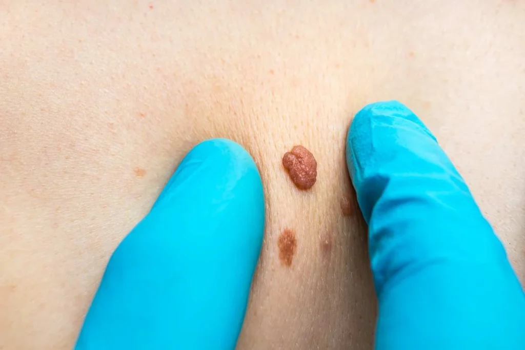 Consultant examining a skin tag Runcorn