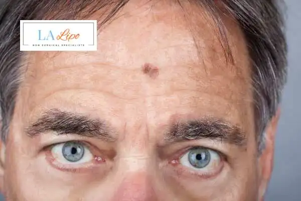 Solar Lentigo Removal Runcorn image of man with mark on his forehead