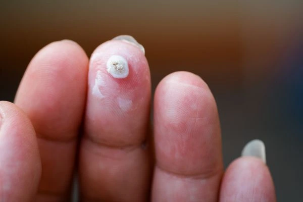 wart on person finger - cryotherapy to treat from LA LIPO Runcorn