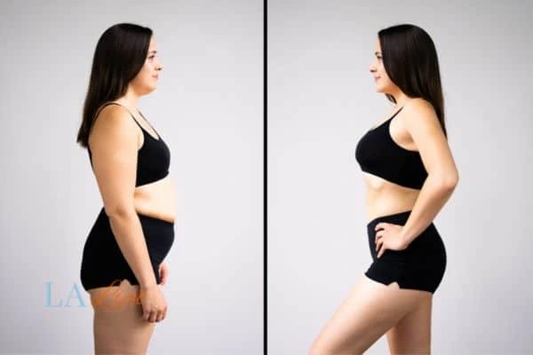 Picture of womans before and after using LA-EMS body sculpting to improve her core strength Runcorn