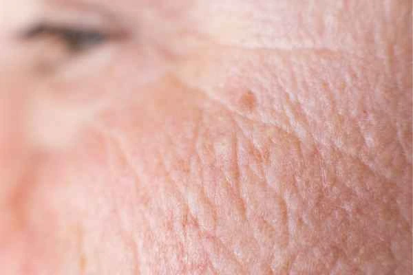 close up picture of a woman's face showing an age spot Runcorn