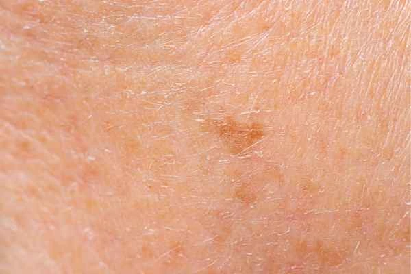 close up picture of age spots Runcorn