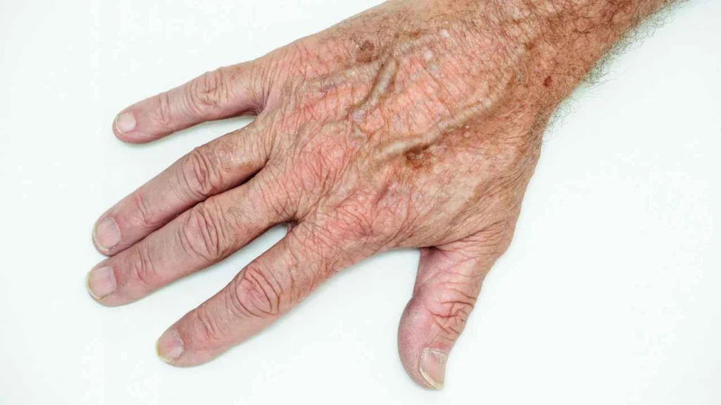 Male hand showing age spot Runcorn