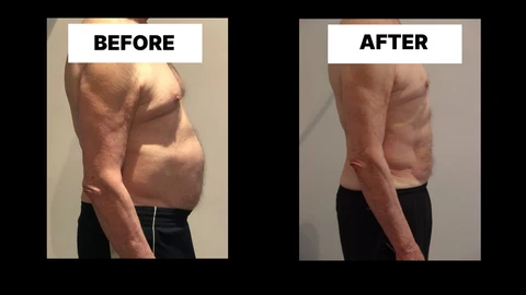 What Symptoms Can Diastasis Recti Cause in Men? Weak Core, Back Pain and Poor Posture Runcorn